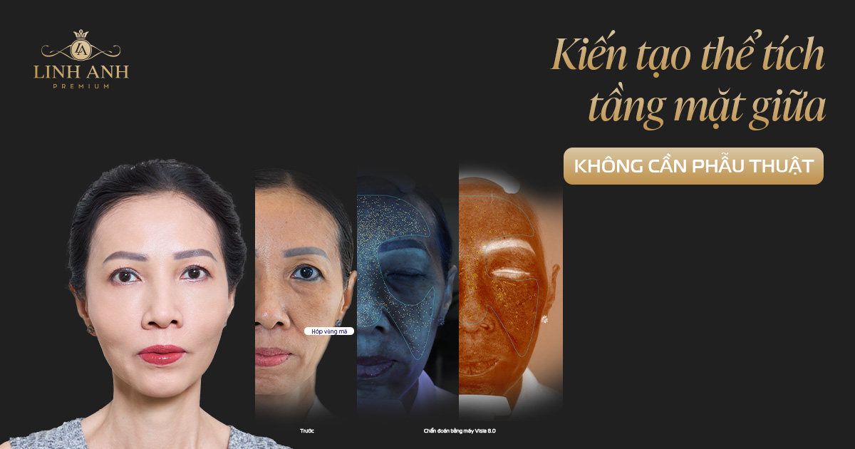 RESTYLIFT: KIẾN TẠO THỂ TÍCH TẦNG MẶT GIỮA  KHÔNG CẦN PHẪU THUẬT