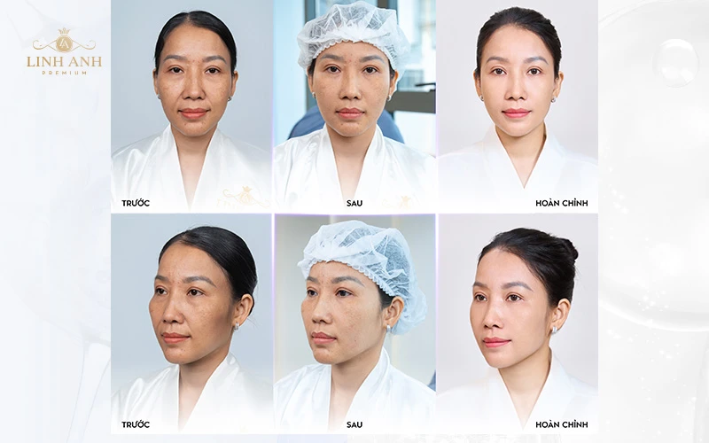 “GIẢI MÃ” CÔNG NGHỆ TRẺ HÓA YOUTHLIFT: KHOA HỌC BẮT ĐẦU TỪ MÁY VISIA 8.0