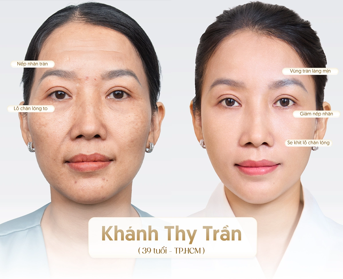 Hiệu quả công nghệ Youthlif1