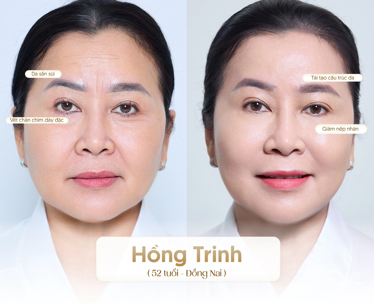 Hiệu quả công nghệ Youthlif2