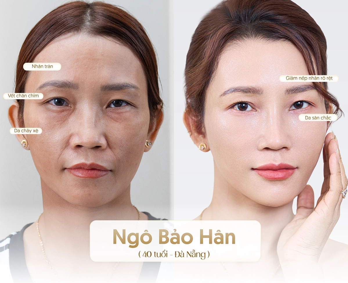 Hiệu quả công nghệ Youthlif3