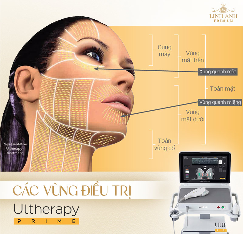 Ai nên dùng Ultherapy Prime