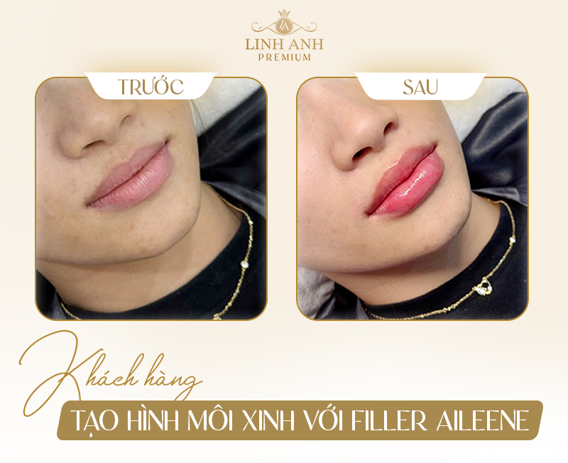 Filler Aileene có tốt không