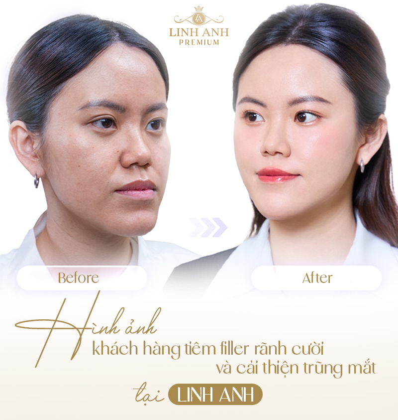 Hình ảnh khách hàng tiêm filler tại phòng khám thẩm mỹ Linh Anh