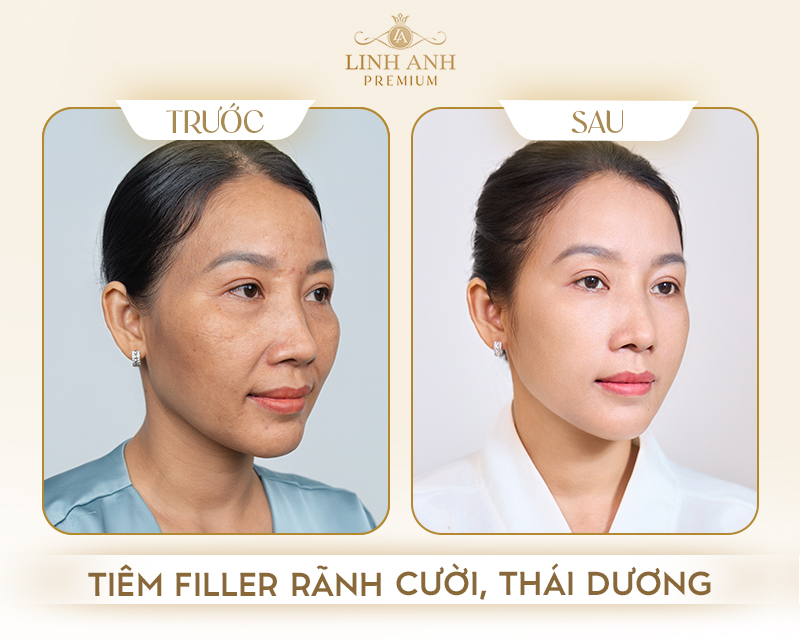 Hình ảnh trước sau khi tiêm filler