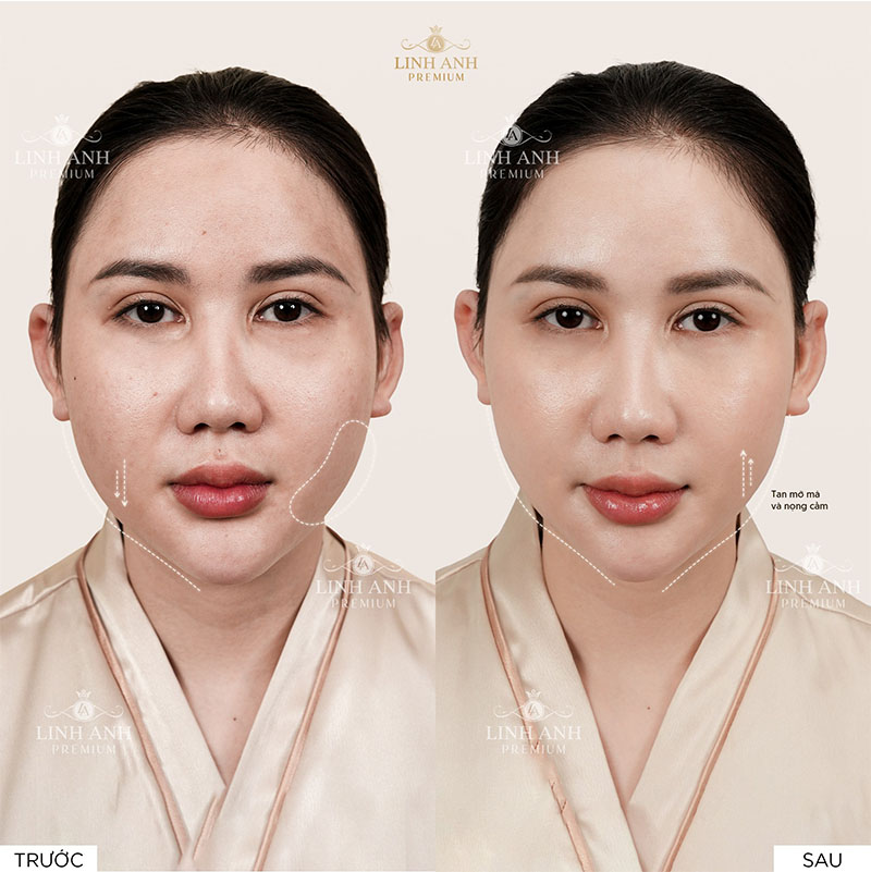Khách hàng điều trị Ultherapy Prime tại Linh Anh Premium