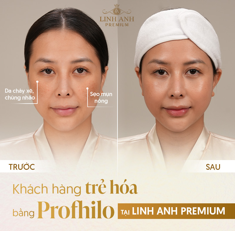 Khách hàng Tiêm Profhilo