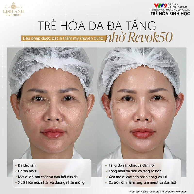 Khách hàng tiêm Revok50 trẻ hóa da