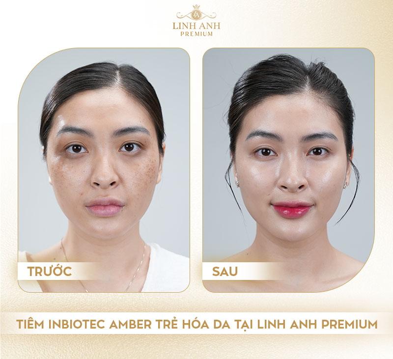 Liệu trình tiêm Inbiotec Amber tại Linh Anh Premium