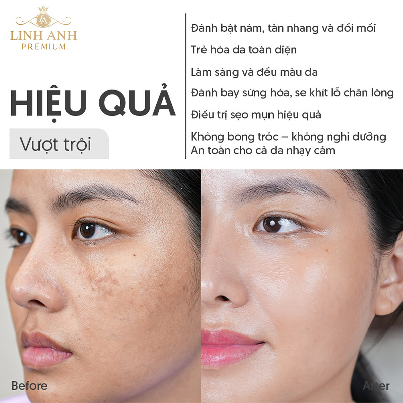 Linh Anh Premium chuyển giao Fotona 6D