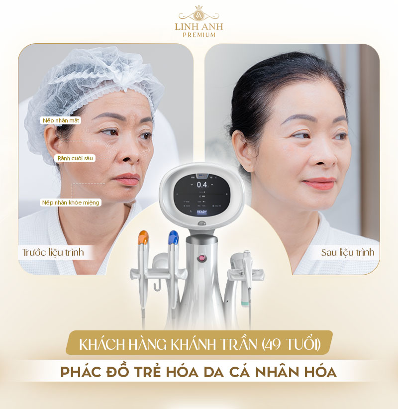 Linh Anh Premium đã chuyển giao công nghệ Ultraformer MPT