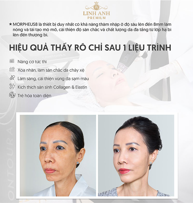 Morpheus8 là công nghệ gì