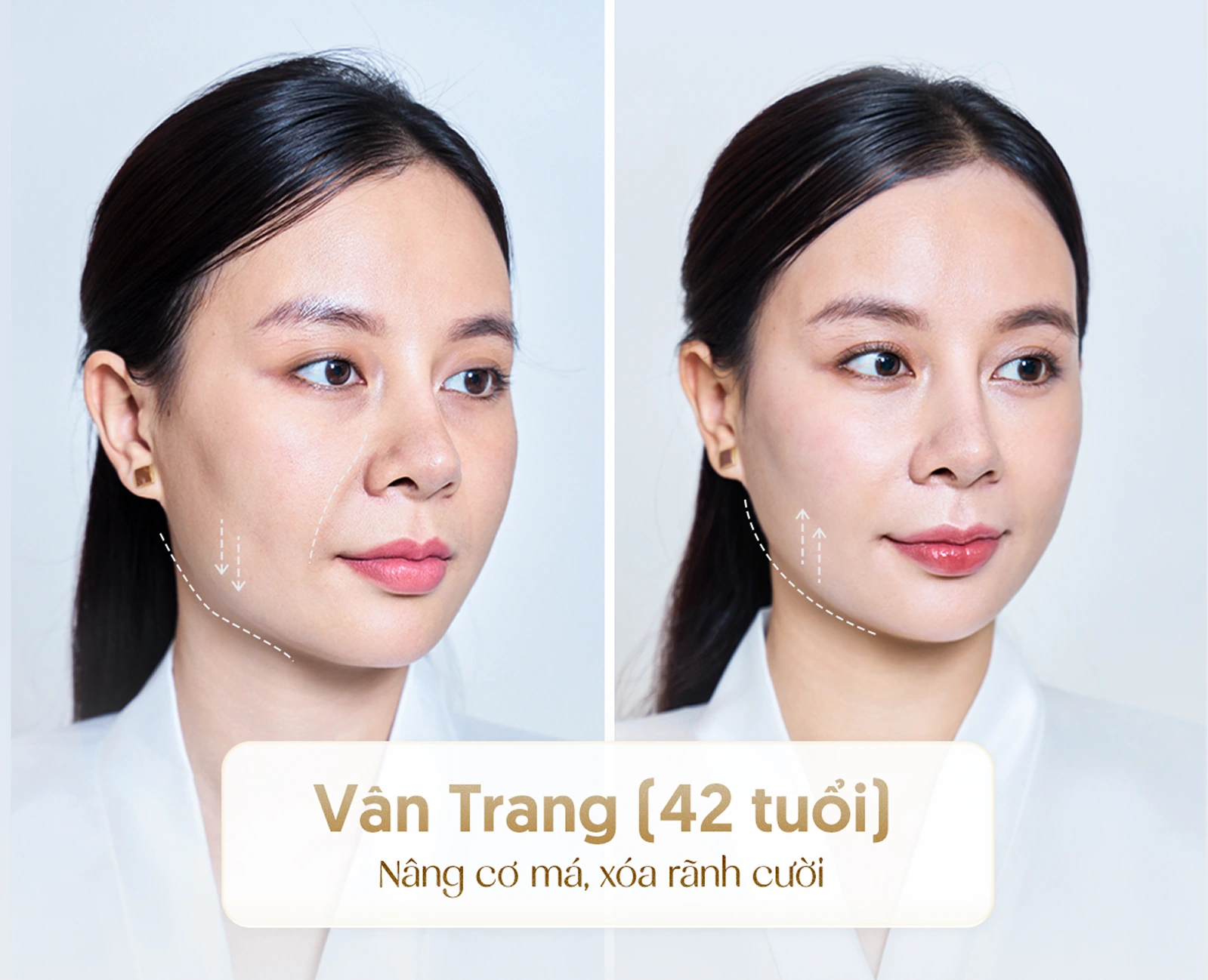 Hiệu quả nâng cơ trẻ hóa công nghệ cao 1