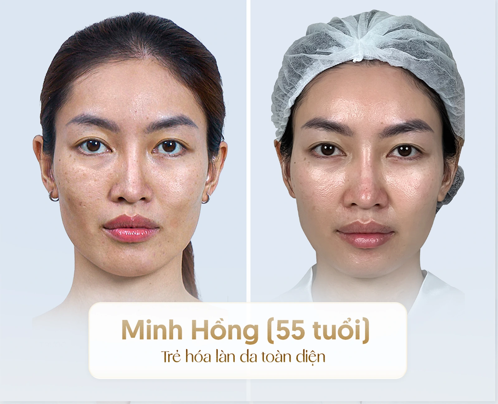 Hiệu quả nâng cơ trẻ hóa công nghệ cao 1