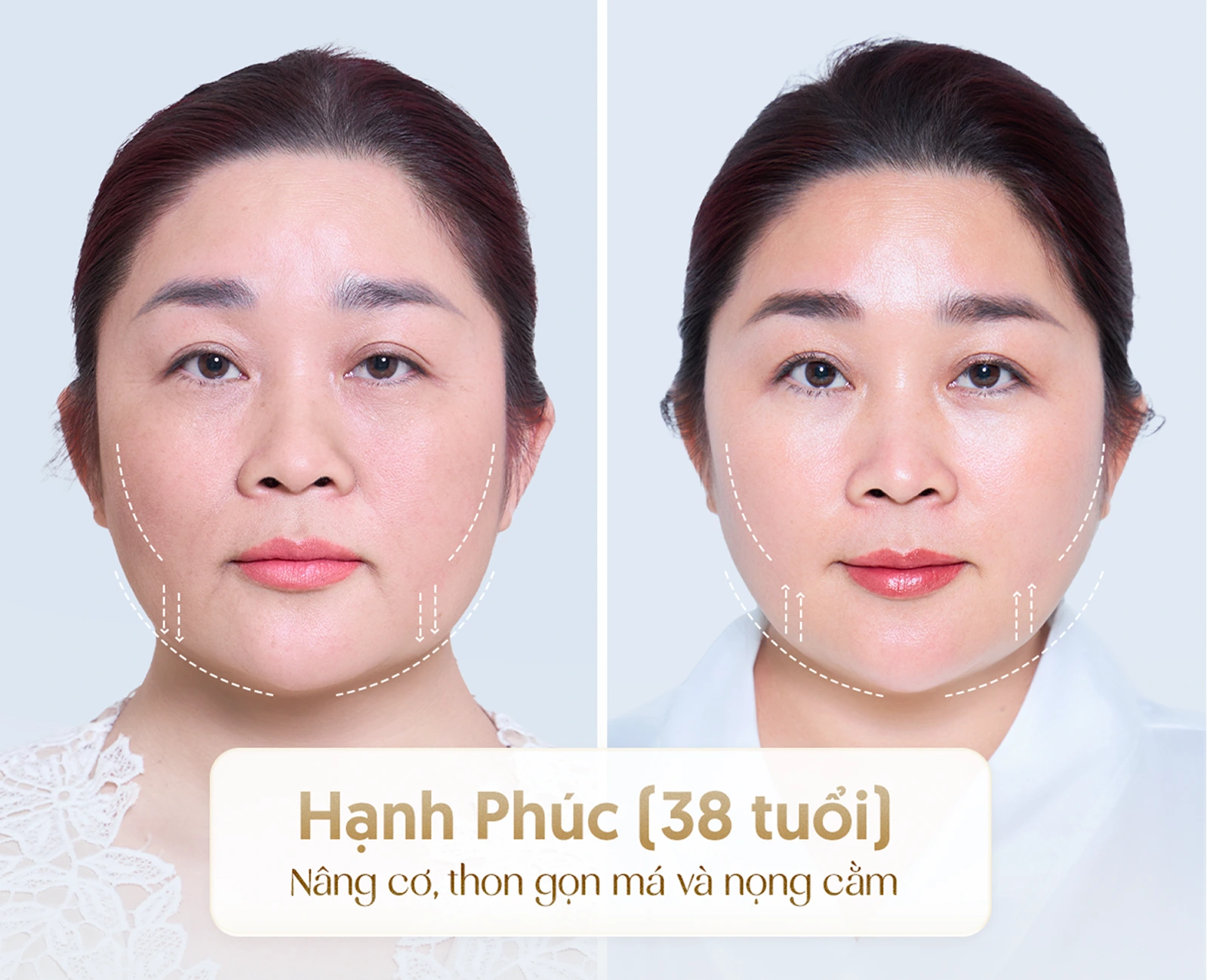 Hiệu quả nâng cơ trẻ hóa công nghệ cao 3