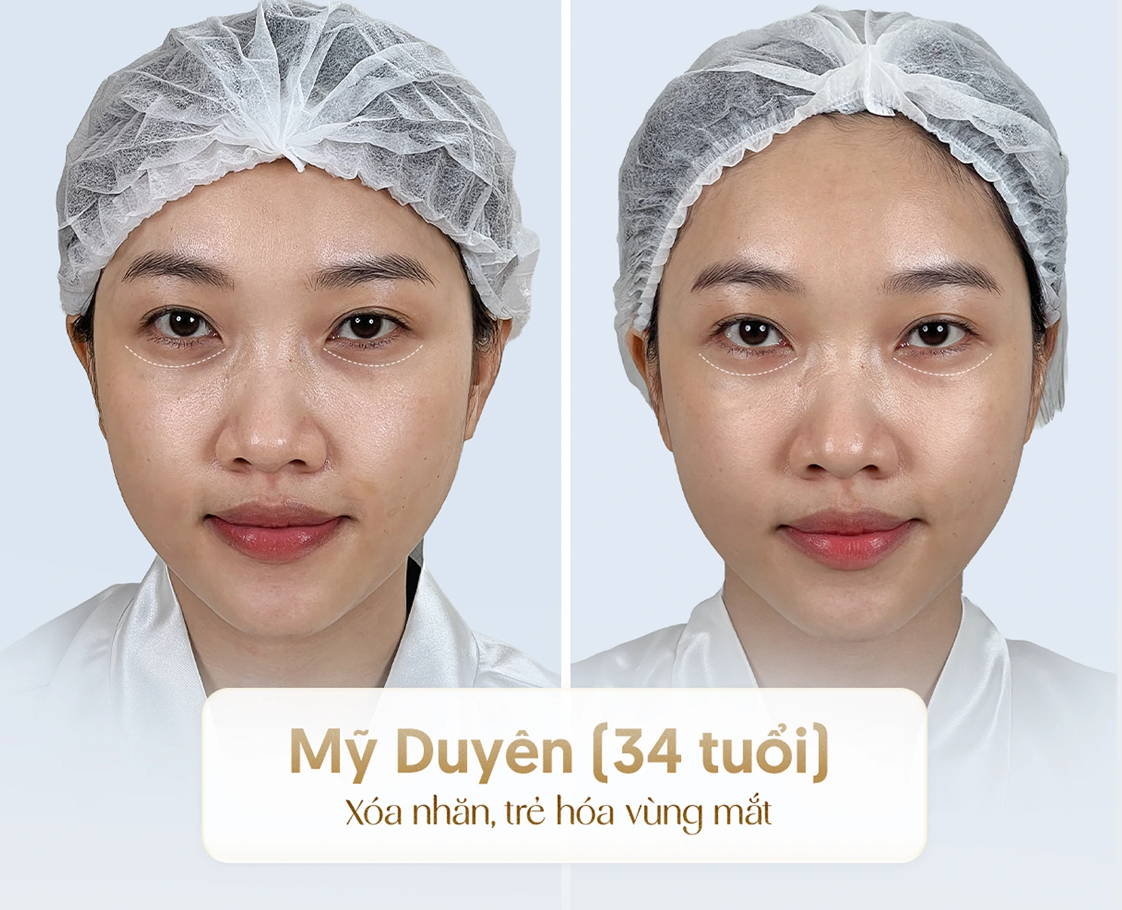 Hiệu quả nâng cơ trẻ hóa công nghệ cao 5