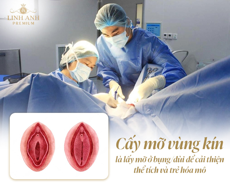 Nên chọn tiêm Filler hay cấy mỡ vùng kín