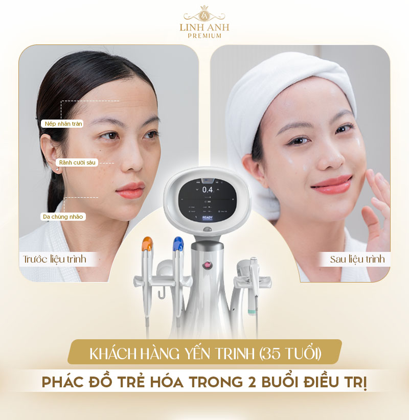 Quy trình thực hiện trẻ hóa bằng Ultraformer MPT