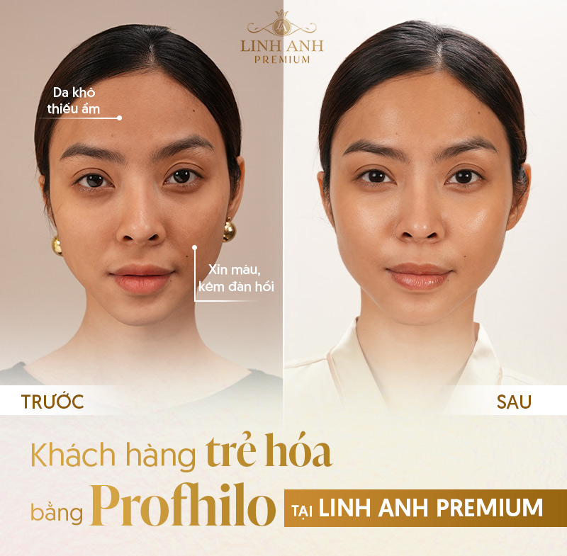 Review Tiêm Profhilo