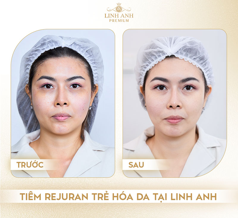 Review tiêm Rejuran Linh Anh Premium