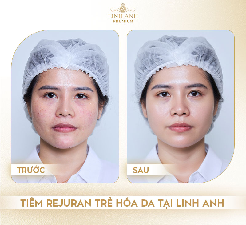 Review tiêm Rejuran