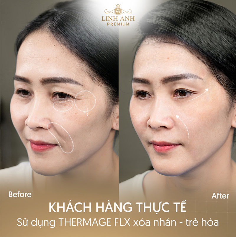 Review trước và sau khi điều trị Thermage FLX
