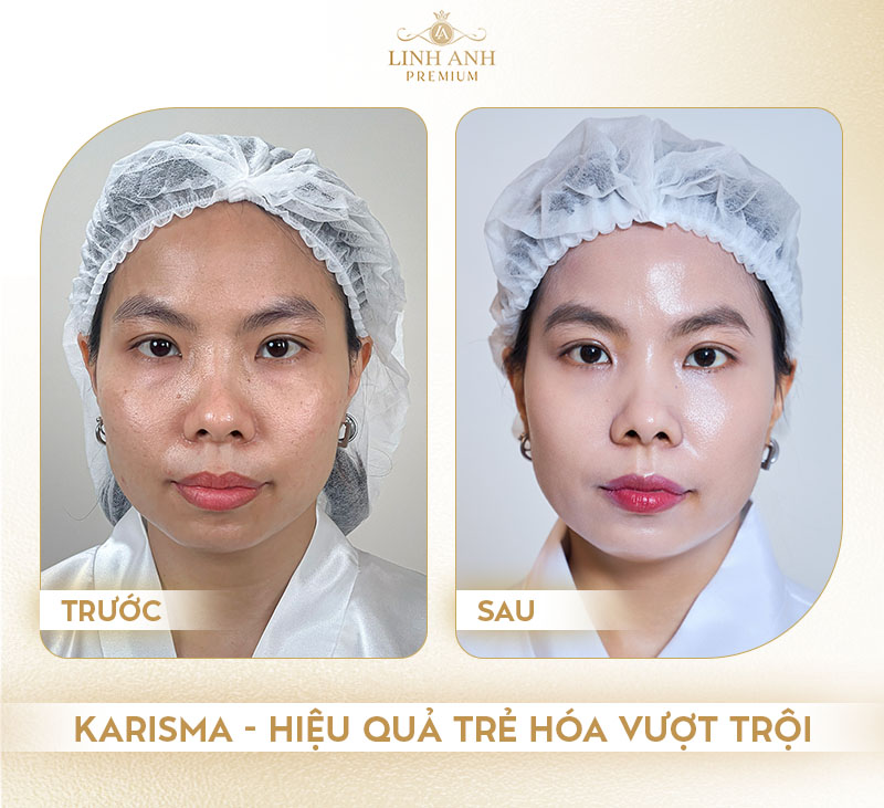 Review trước và sau khi tiêm Karisma