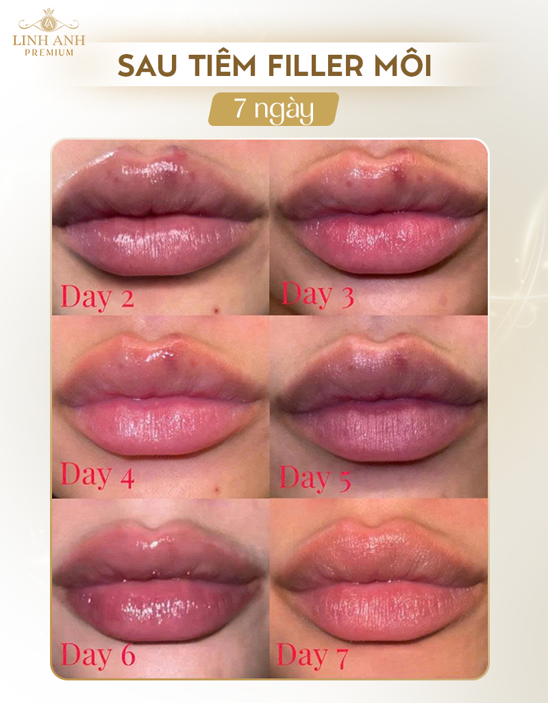 Sau khi tiêm filler môi bao lâu thì mềm Sau khi tiêm filler môi bao lâu thì mềm
