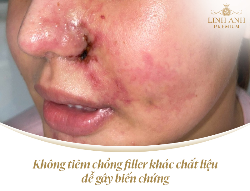 Tiêm 2 loại filler khác nhau có làm sao không