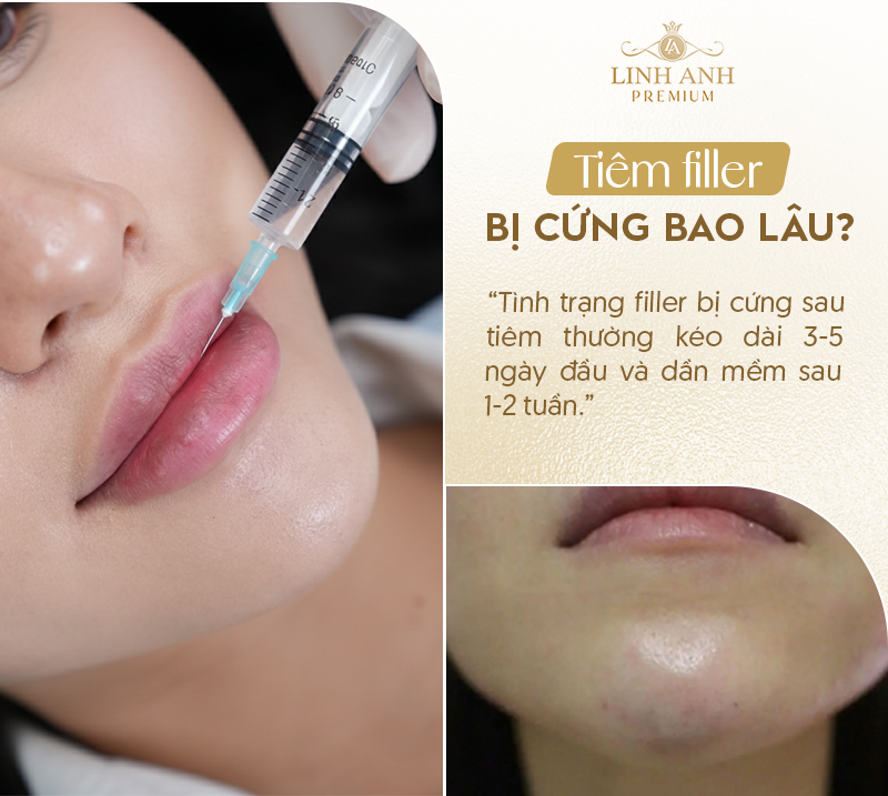 Tiêm filler bị cứng bao lâu