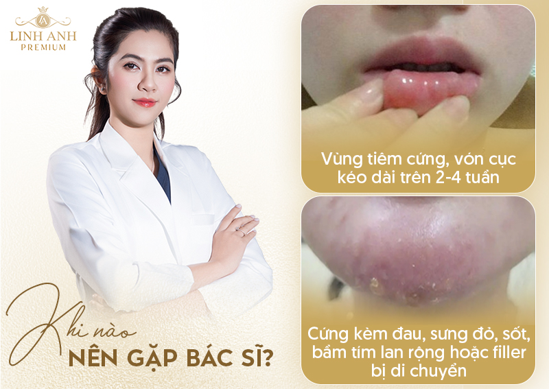 Tiêm filler cằm bị cứng bao lâu