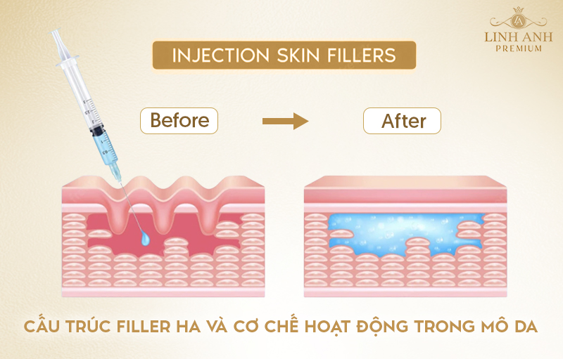 tiêm filler là gì