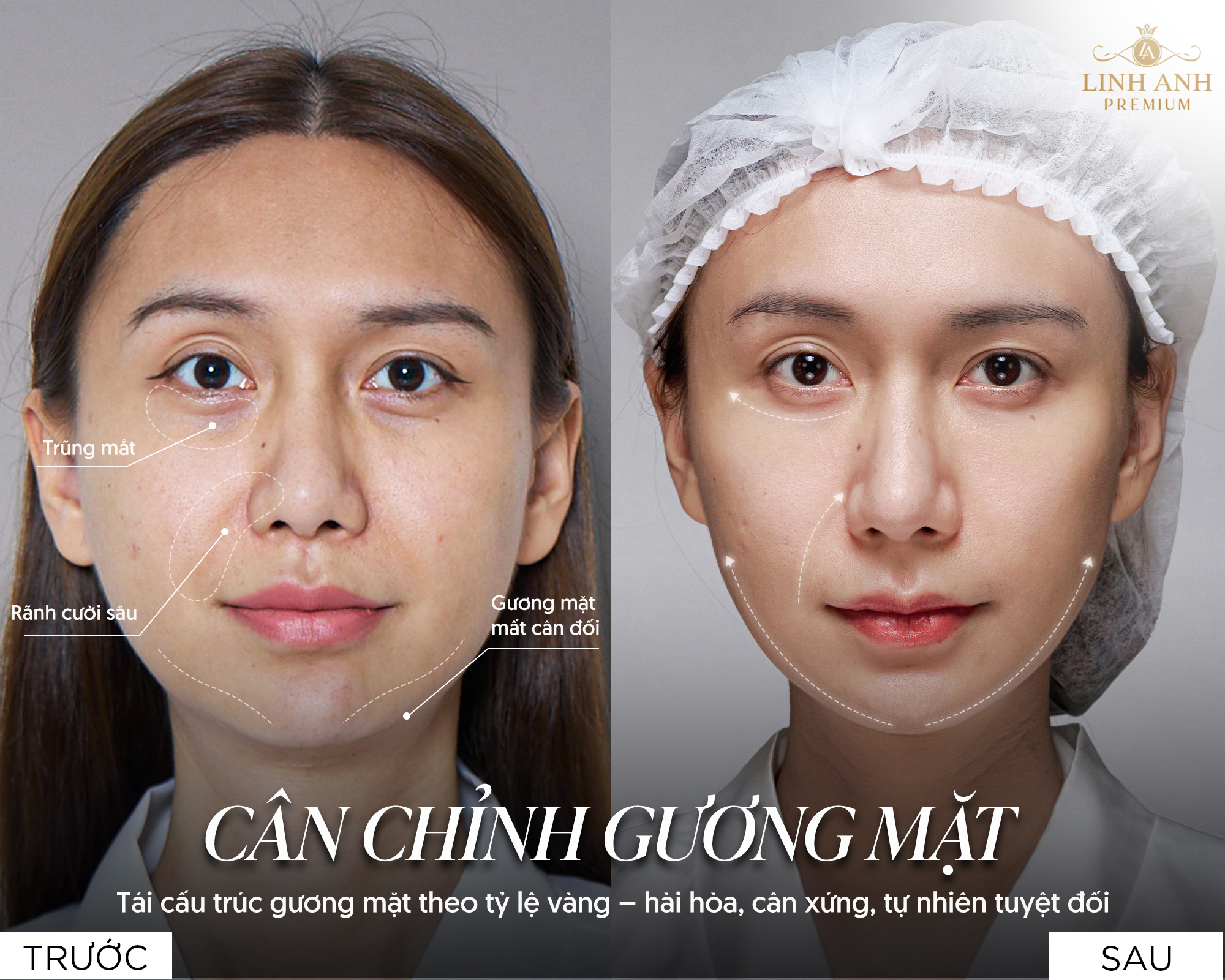 Tiêm filler về già có ảnh hưởng gì không