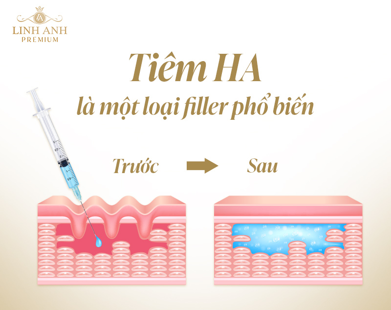 Tiêm filler có phải HA không