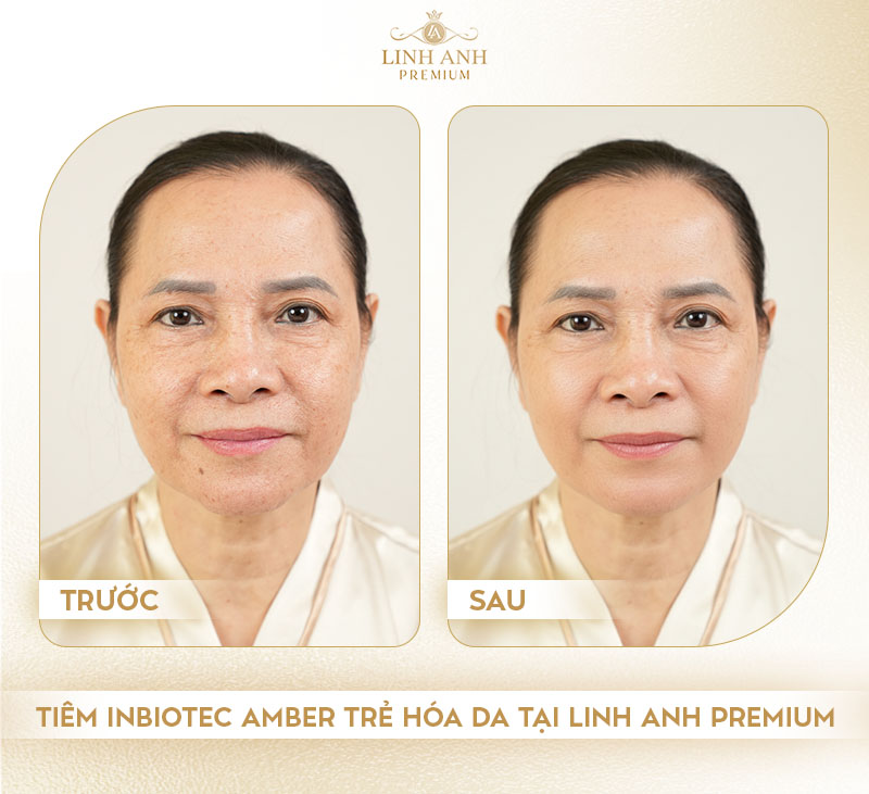 Tiêm Inbiotec Amber trẻ hóa da tại Linh Anh Premium