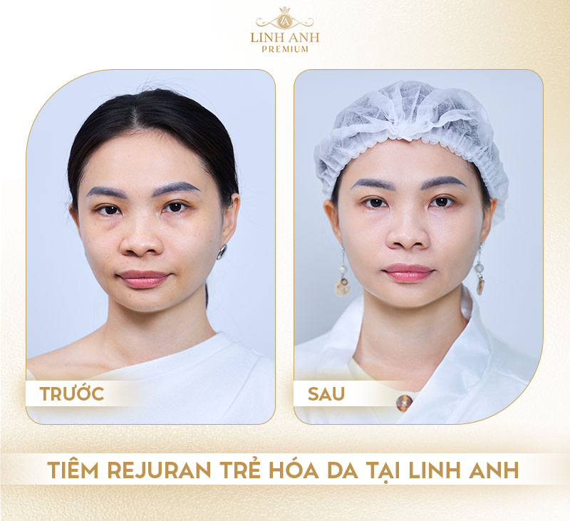 Tiêm Rejuran ở đâu - Linh Anh Premium
