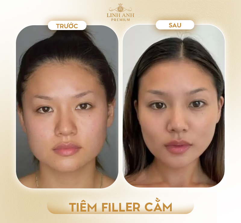 Hình ảnh trước và sau khi tiêm cằm