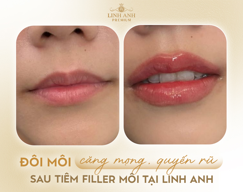 Tiêm filler môi cần kiêng gì