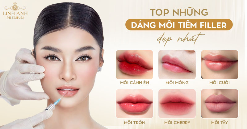 Các dáng môi tiêm filler tự nhiên, hot trend 2026