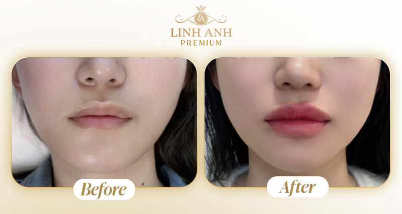 Dáng môi tiêm filler đẹp