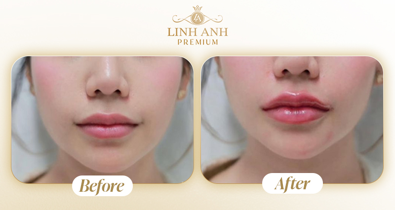 Dáng môi tiêm filler tự nhiên