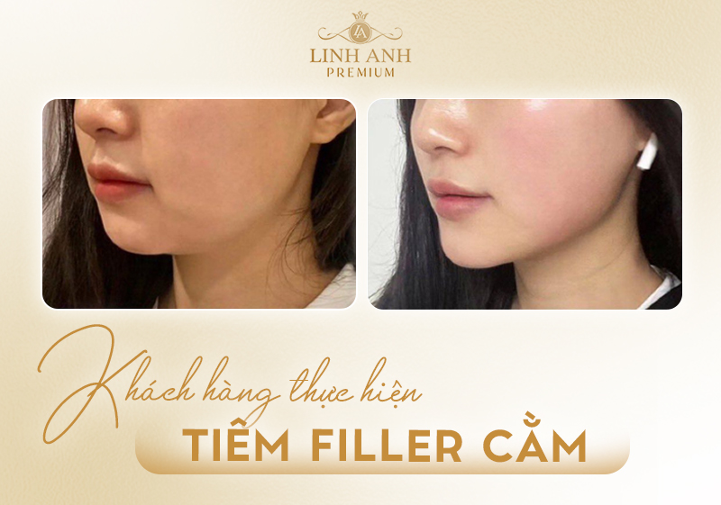 giá tiêm filler cằm
