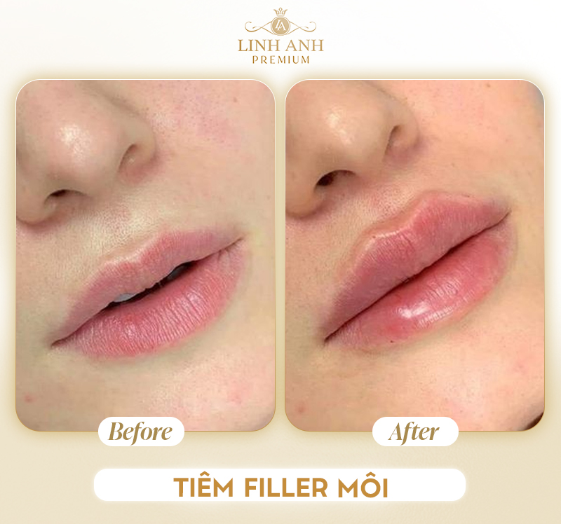 Giá tiêm môi baby