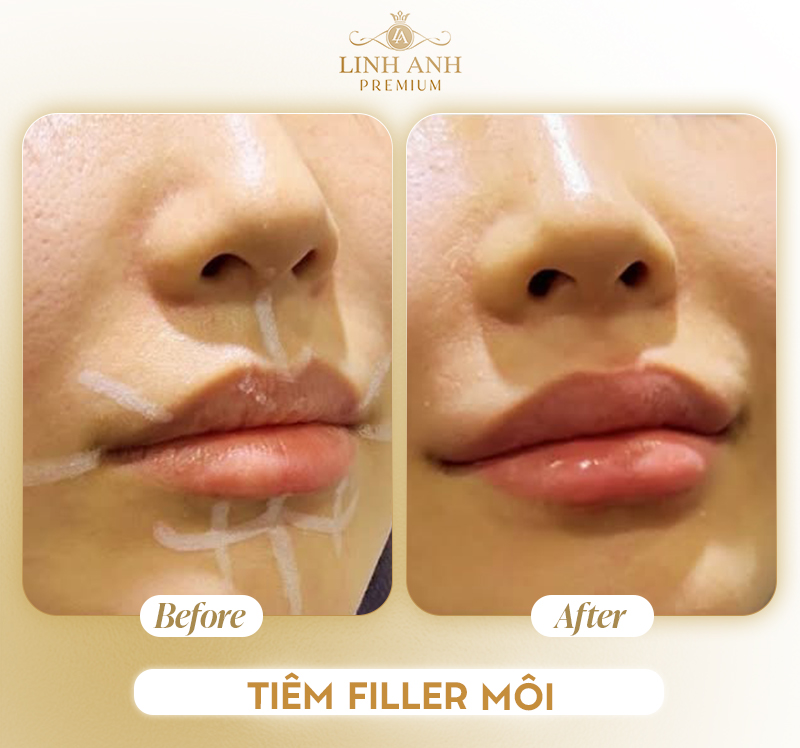 Hình ảnh trước và sau khi tiêm filler môi Hình ảnh trước và sau khi tiêm filler môi