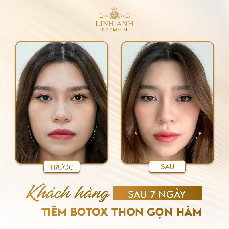 Review tiêm botox gọn hàm