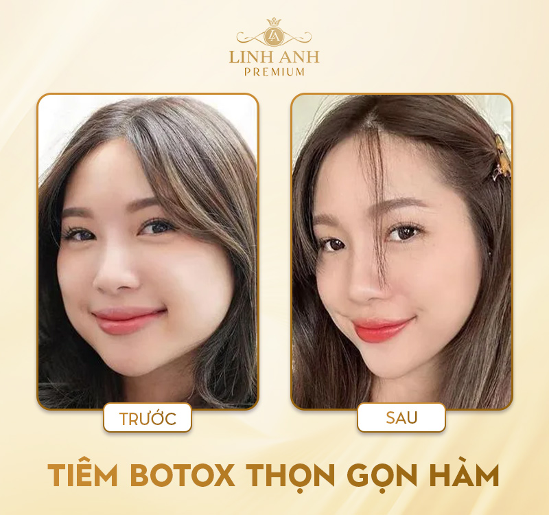 Review Tiêm gọn hàm