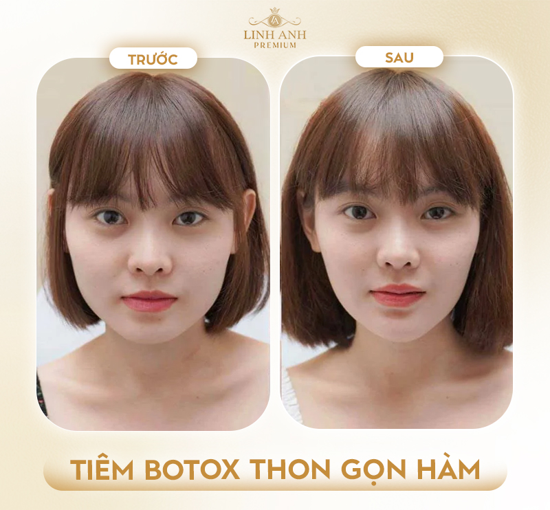 tiêm botox gọn hàm nhiều lần có sao không