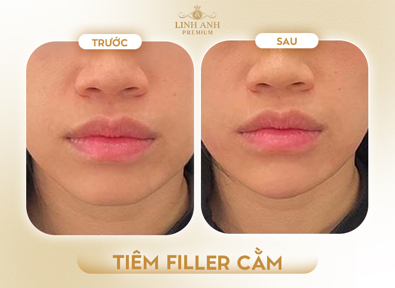 Tiêm filler cằm trước và sau