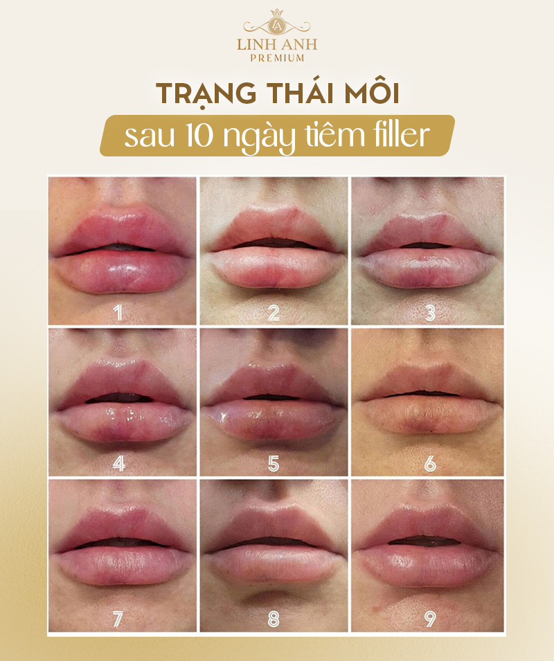 Tiêm filler môi bao lâu hết sưng