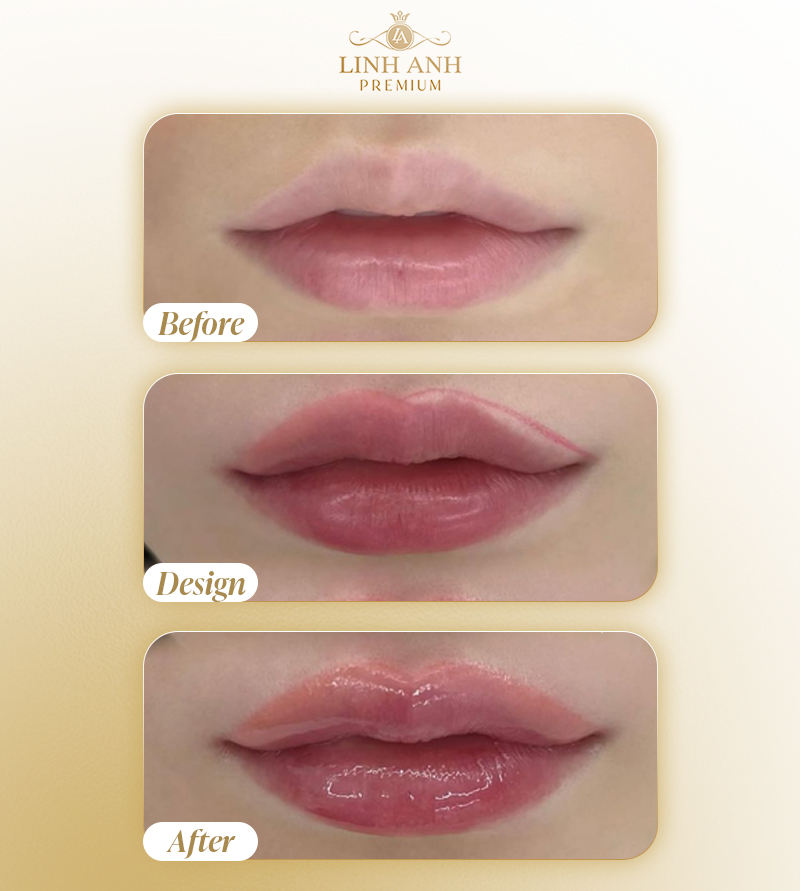 Trước và sau khi tiêm Filler